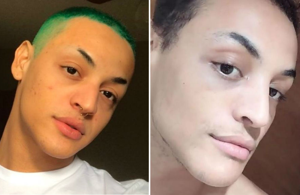 pabllo-vittar-antes-e-depois-cirurgia-nariz