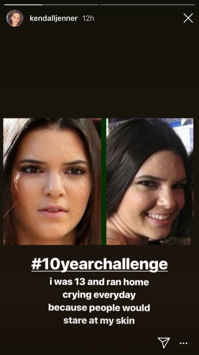 kendall-jenner-acne-pele kendall-jenner-acne-pele