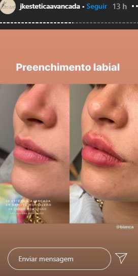 bianca-andrade-procedimentos-esteticos-1