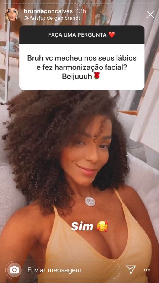 brunna goncalves harmonizacao facial (1) brunna goncalves harmonizacao facial (1)
