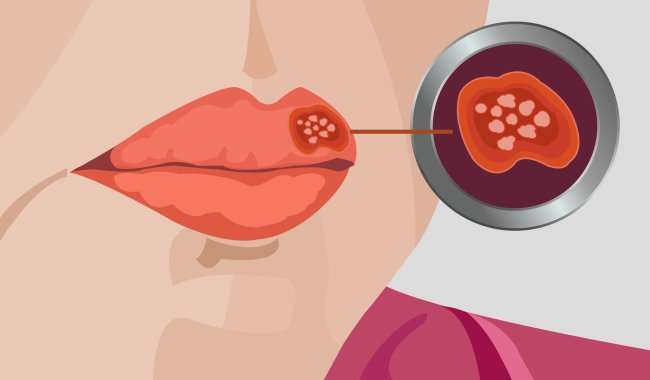 Herpes: o que é, quais os tipos, sintomas e tratamentos, e como transmite Ilustração da herpes labial, com uma boca com feridinhas