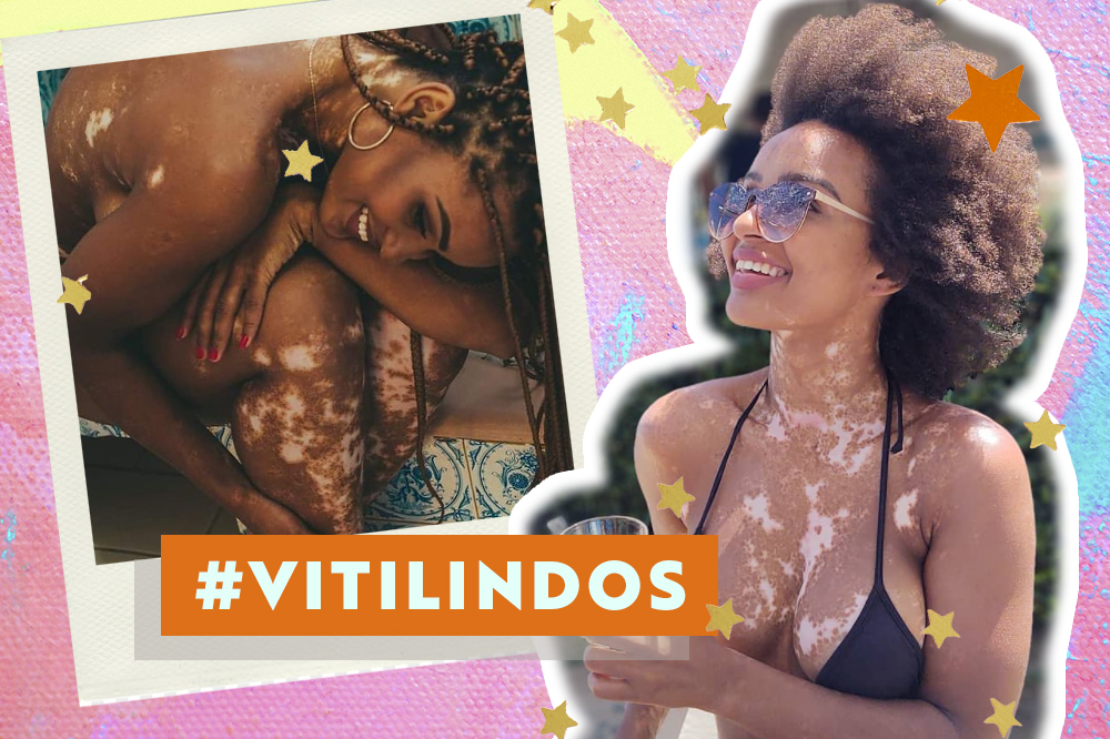 Fotos da Natália, do BBB. Ela é uma mulher negra com vitiligo. Nas fotos, ela aparece de biquíni, sorrindo