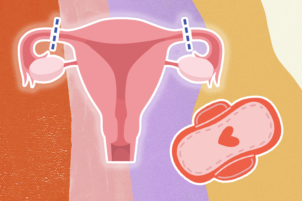Ilustração do procedimento de laqueadura, em que as trompas são cortadas, e de um absorvente externo com um coração no meio