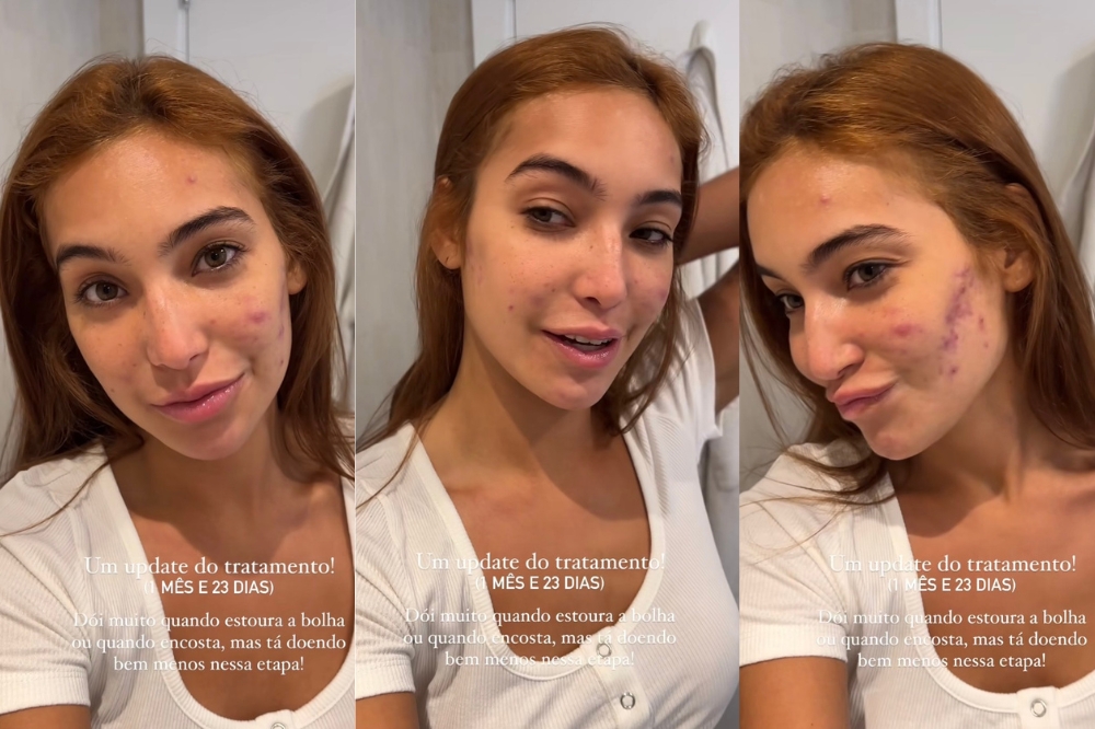 Vanessa Lopes mostra pele durante tratamento para acne