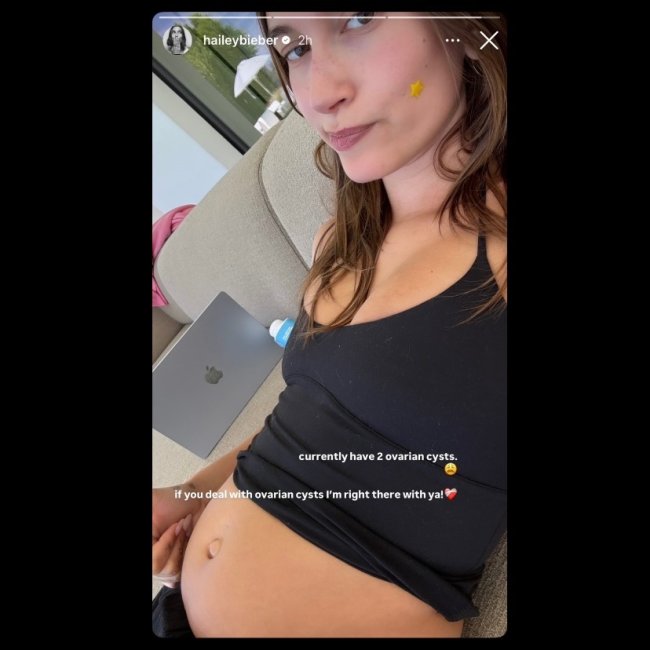 hailey bieber cisto no ovário Hailey Bieber mostra abdômen inchado por conta de dois cistos no ovário.