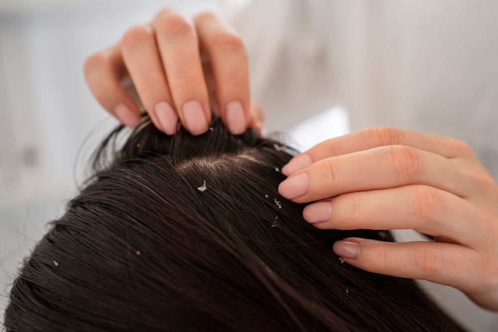 como-cuidar-problemas-cabelo (3) Como cuidar da caspa
